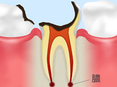 4：歯根に達した虫歯