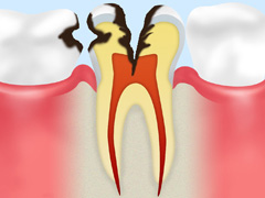 C3以上の歯には根管治療を